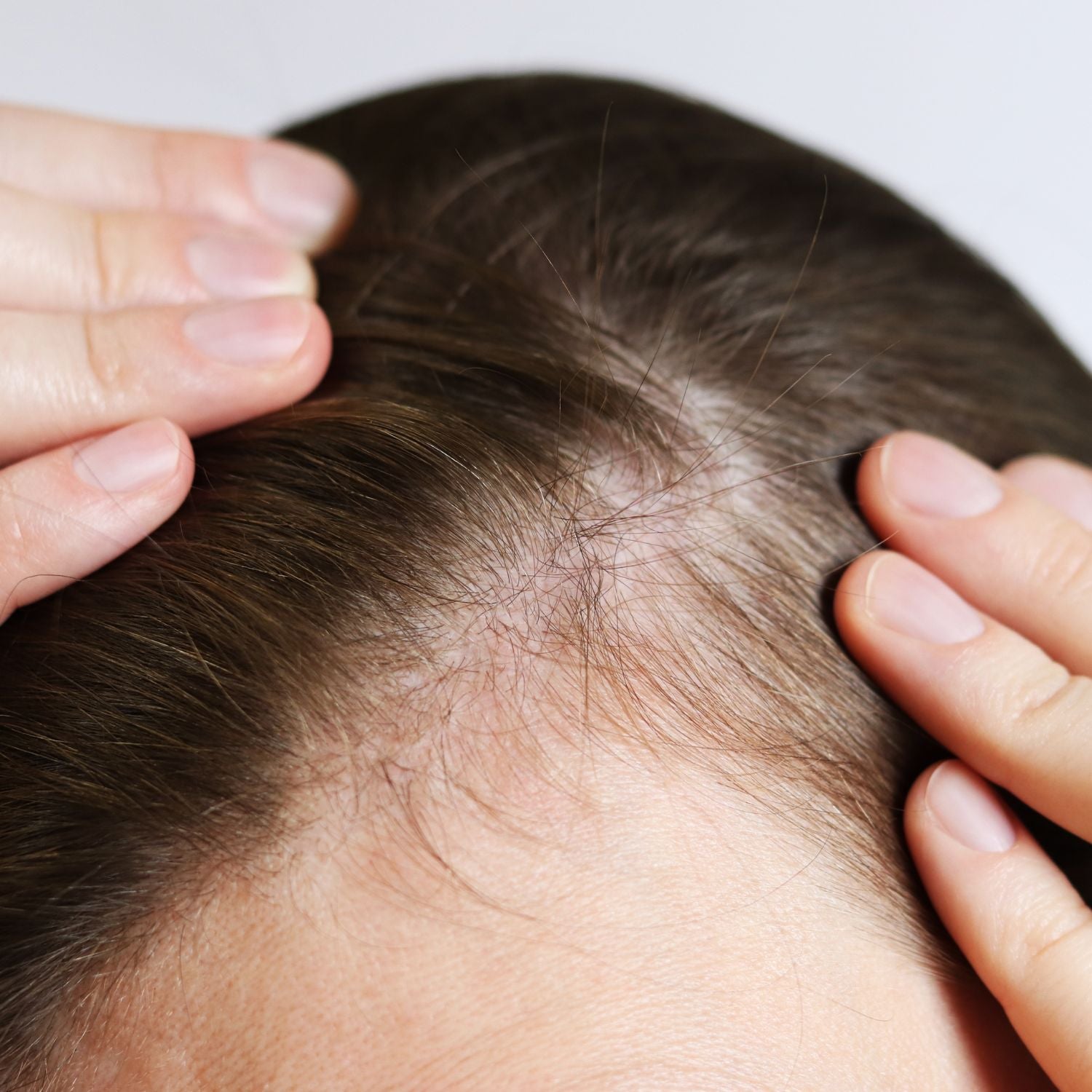 Scalp Inflammation: The Root of the Problem